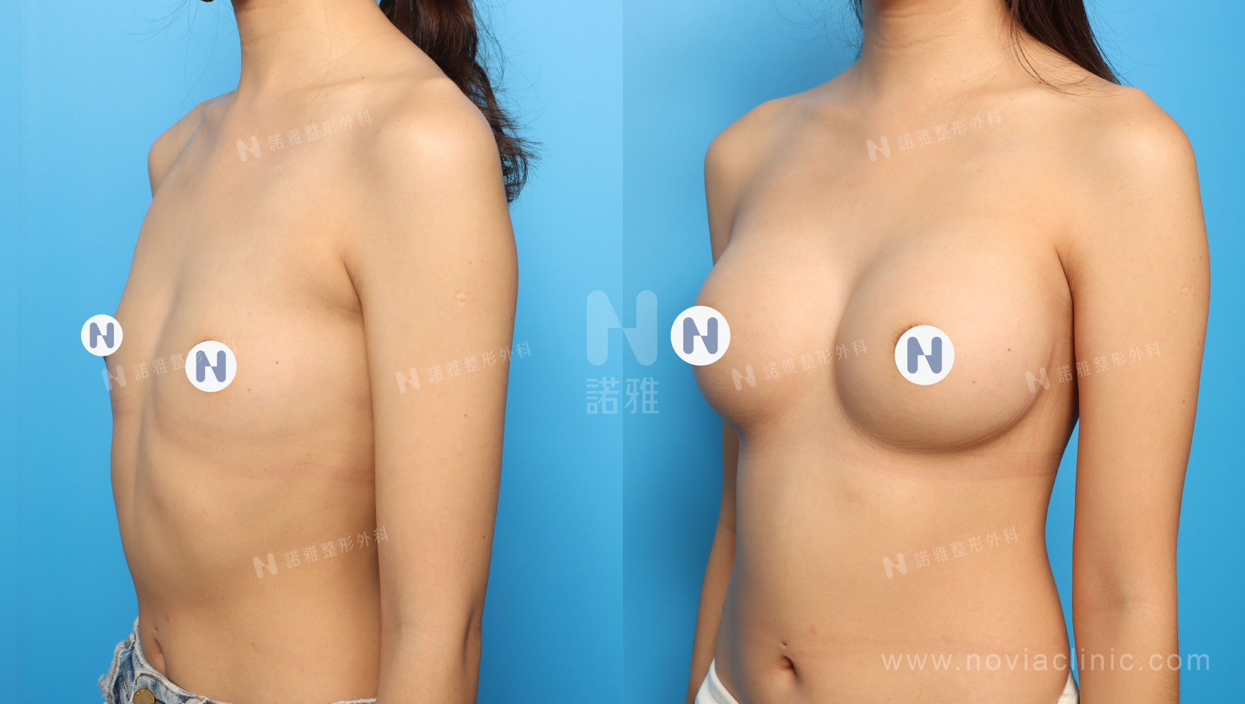 珍珠波隆乳手術